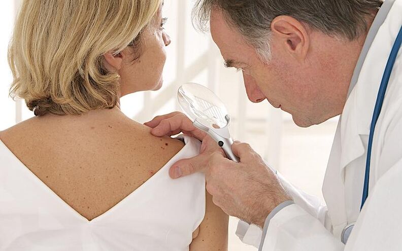 Woman with papilloma at the doctor's appointment before taking Removio gel