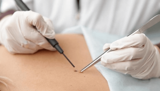 Features of removal of papilloma