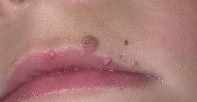 Papillomas on the lips
