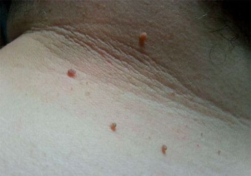 Papillomas on the neck