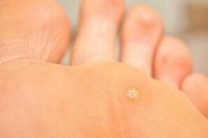 Why do plantar warts appear