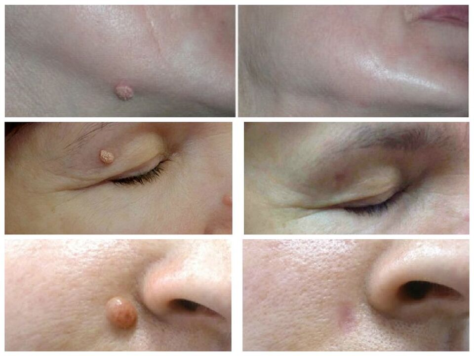 successful elimination of warts after using Rimovio gel review from Andrew 1