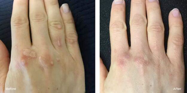 successful elimination of warts after using Rimovio gel review from Andrew 2